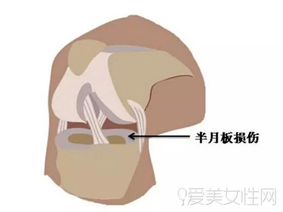 半月板磨损怎么办(图1)